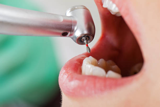 Best Emergency Root Canal Treatment in Clintondale, NY